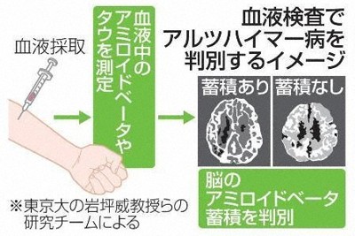 血液検査で認知症判別　国内初の大規模実証に成功　東大など