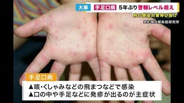 『手足口病』大阪で5年ぶり警報レベル超え　咳などで飛沫感染　有効なワクチンなし「感染対策を徹底して」