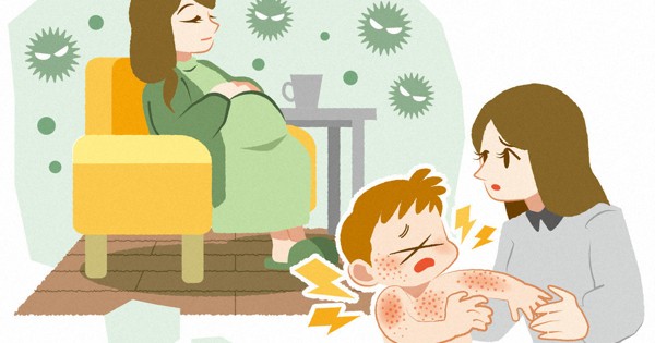 小児湿疹の発症　妊娠期に住む家の床材も影響か　北大など論文