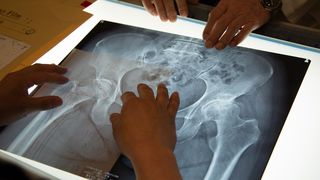 中高年女性を襲う股関節の痛み──妻の人工股関節置換手術を撮る