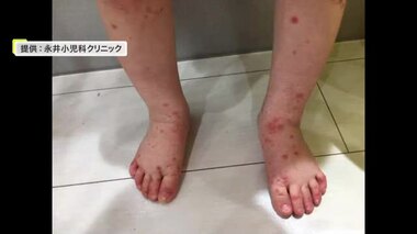 手足口病　宮城県でも警報発表　大崎保健所では患者が２倍に増加　手洗いうがいの徹底を