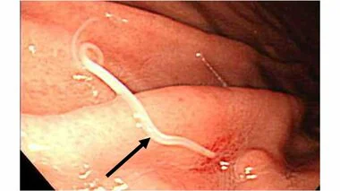 粘膜にもぐり込み穴が空くことも！？胃や腸に激痛が走るアニサキス症…疑いがあったらどうすればいいのか聞いた